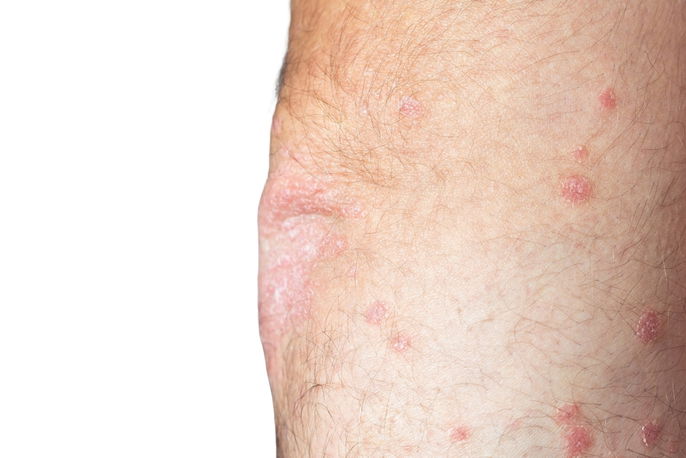 close up of pemphigus on an arm