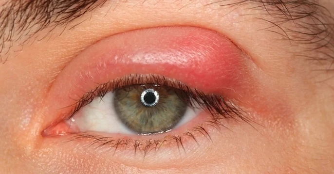 Ojo con un orzuelo en el párpado