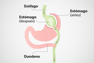 Imagen ilustrativa del artículo Bypass gástrico: qué es, indicaciones y cómo se realiza