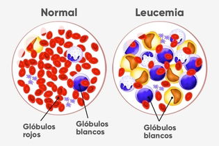 Imagen ilustrativa del artículo Leucemia: tipos, síntomas, causas y tratamiento