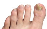Illustrative image of the article What is the most effective treatment for toenail fungus?