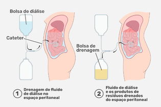 Imagem ilustrativa do artigo Diálise peritoneal: o que é, como funciona e indicações