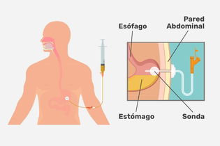 Imagen ilustrativa del artículo Gastrostomía: qué es, alimentación y cuidados