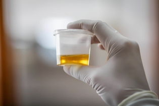 Illustrative image of the article Urine Color Chart: What Clear, Yellow, Green or Red Urine Means