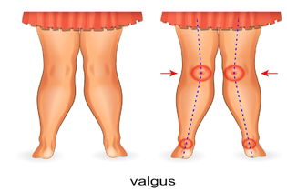 Imagen ilustrativa del artículo Genu valgo: qué es, diagnóstico y tratamiento