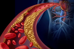 Imagem ilustrativa do artigo Dislipidemia: o que é, como identificar, causas e tratamento