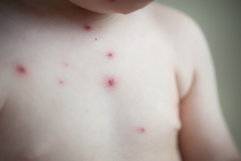Illustrative image of the article Chickenpox: Symptoms, Causes & Treatment