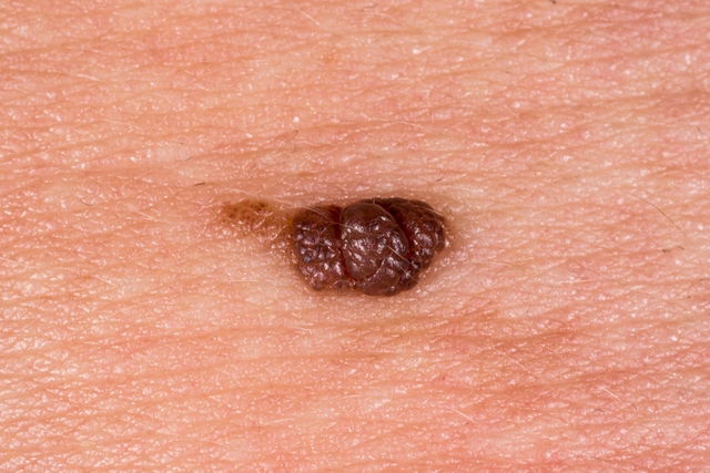 Illustrative image of the article Warts: Symptoms, 5 Types (w/ Pictures) & Treatment