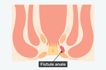 Image illustrative de l'article Fistule anale: c'est quoi, symptômes, traitement et chirurgie