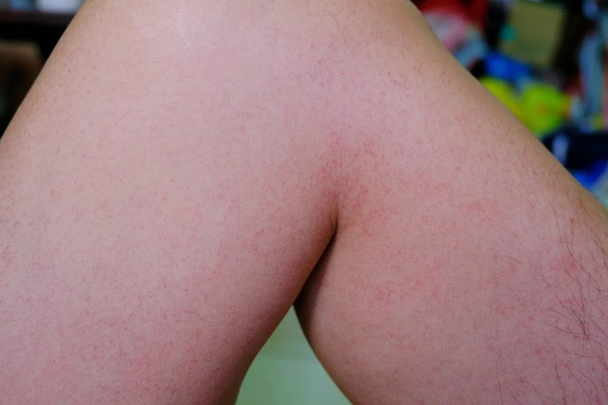 dengue