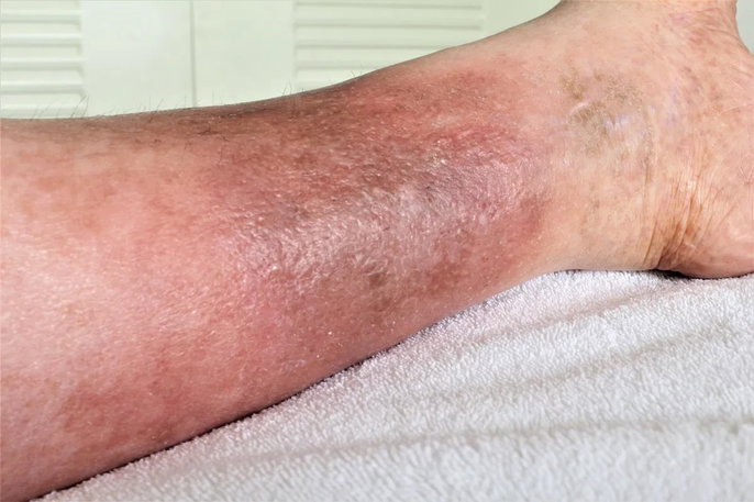 poor circulation
