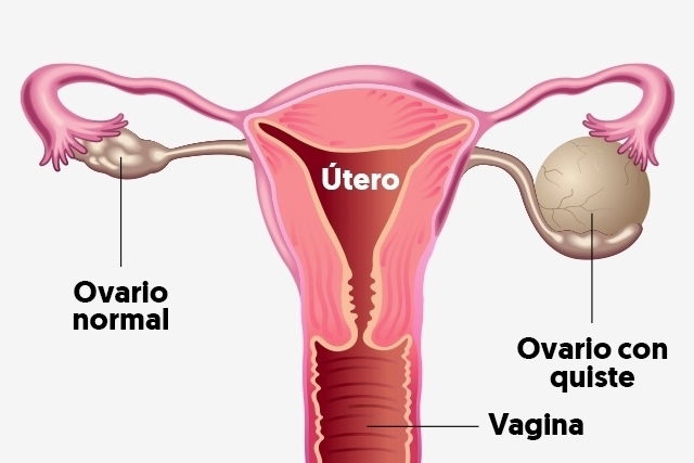 Quistes en los ovarios sintomas por que salen tipos y tratamiento Tua Saude