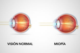 Imagen ilustrativa del artículo Miopía: qué es, causas y tratamiento