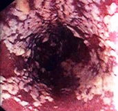 Imagen ilustrativa del artículo Candidiasis intestinal: síntomas y tratamiento