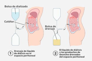 Imagen ilustrativa del artículo Diálisis peritoneal: qué es, cómo funciona y otras dudas