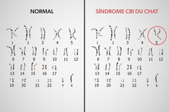 Imagem ilustrativa do artigo Síndrome de Cri du Chat: o que é, sintomas, causas e tratamento