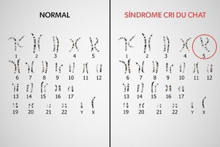 Imagem ilustrativa do artigo Síndrome de Cri du Chat: o que é, sintomas, causas e tratamento