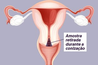 Imagem ilustrativa do artigo Conização: para que serve, como é feita, recuperação e complicações