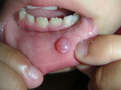 Illustrative image of the article Mucous Cyst: Symptoms, Causes & Treatment