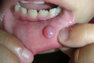 Illustrative image of the article Mucocele (Mucous Cyst): Symptoms, Causes & Treatment