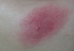 Illustrative image of the article Spider Bites: How to Identify & Treat Them