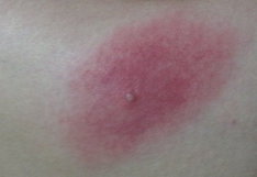 Illustrative image of the article Spider Bites: How to Identify & Treat Them