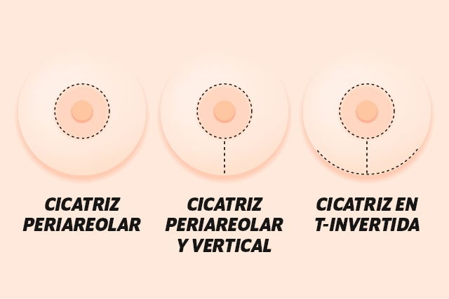 Tipos de mastopexia