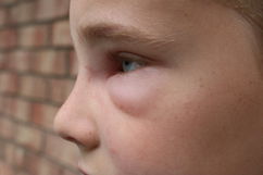 Imagem ilustrativa do artigo Celulite ocular: o que é, sintomas e como tratar (é contagiosa?)