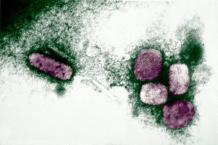 Image illustrative de l'article Variole: symptômes, transmission et traitement