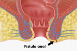 Imagen ilustrativa del artículo Fístula anal: qué es, síntomas y tratamiento  