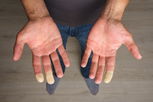 Illustrative image of the article Raynaud’s Syndrome: Symptoms, Causes, Diagnosis & Treatment