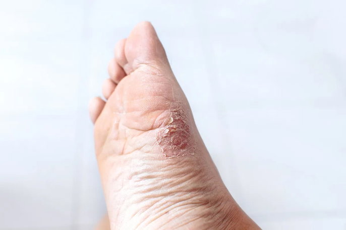fungal infections