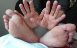 Image illustrative de l'article Syndrome pieds-mains-bouche: symptômes, transmission et traitement