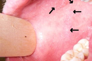 Illustrative image of the article 8 Measles Symptoms (with Rash Photos & Online Quiz)