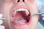 Illustrative image of the article Dry Socket: Symptoms, Causes, Treatment & When to See A Dentist