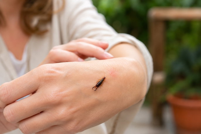 Woman with earwig bite on hand | AI-generated image