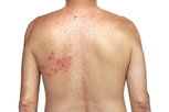 Illustrative image of the article Shingles: Symptoms, Causes, & Treatment