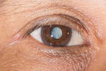 Illustrative image of the article White Spot on Eye: Common Causes & Treatment