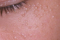 Illustrative image of the article Milia: Causes, Symptoms & Treatment