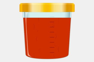 Illustrative image of the article Red Urine: 11 Common Causes & What to Do