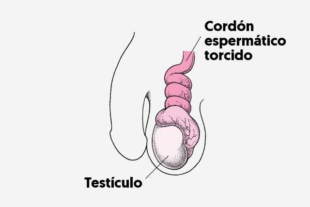 Torsión testicular