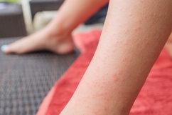 Illustrative image of the article Dermatitis Herpetiformis: Symptoms, Causes & Treatment