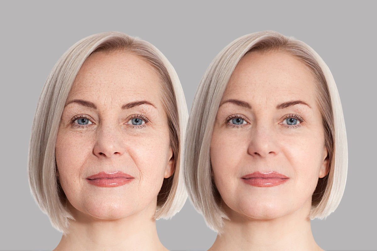 Aplicación PDRN Salmón