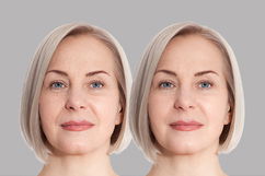 Imagen ilustrativa del artículo Bótox: qué es, para qué sirve y cómo se aplica