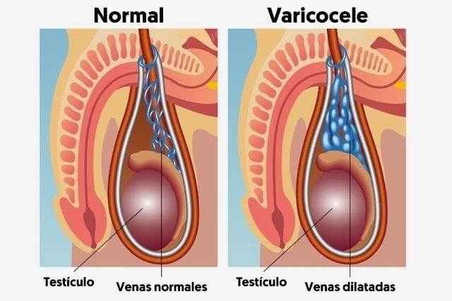 Varicocele