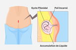 Image illustrative de l'article Kyste pilonidal: symptômes, causes et traitement