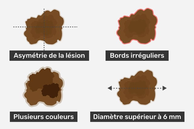 image qui illustre les différentes caractéristiques des lésions à observer