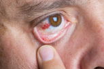 Illustrative image of the article Red Spot on Eye: Common Causes & When to See a Doctor
