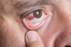 Illustrative image of the article Red Spot on Eye: Common Causes & When to See a Doctor