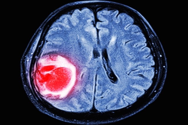 blood clot in the brain on imaging